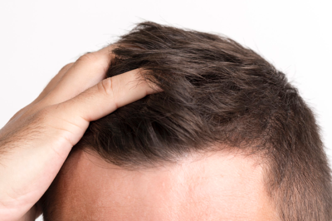 Hair Transplant in delhi