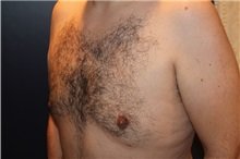 gynecomastia after image