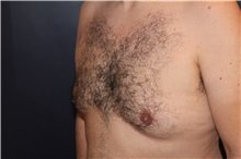gynecomastia before image